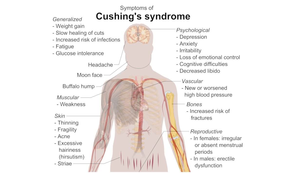 Enfermedad de Cushing, síndrome